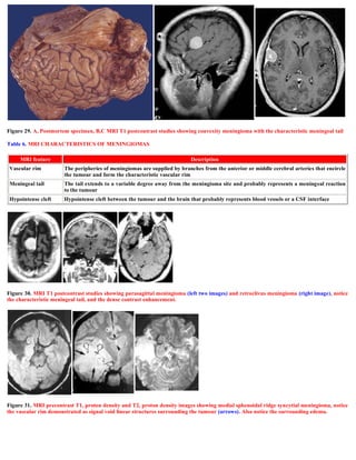 Figure 29. A, Postmortem specimen, B,C MRI T1 postcontrast studies showing convexity meningioma with the characteristic meningeal tail
Table 6. MRI CHARACTERISTICS OF MENINGIOMAS
Figure 30. MRI T1 postcontrast studies showing parasagittal meningioma (left two images) and retroclivus meningioma (right image), notice
the characteristic meningeal tail, and the dense contrast enhancement.
Figure 31. MRI precontrast T1, proton density and T2, proton density images showing medial sphenoidal ridge syncytial meningioma, notice
the vascular rim demonstrated as signal void linear structures surrounding the tumour (arrows). Also notice the surrounding edema.
MRI feature Description
Vascular rim The peripheries of meningiomas are supplied by branches from the anterior or middle cerebral arteries that encircle
the tumour and form the characteristic vascular rim
Meningeal tail The tail extends to a variable degree away from the meningioma site and probably represents a meningeal reaction
to the tumour
Hypointense cleft Hypointense cleft between the tumour and the brain that probably represents blood vessels or a CSF interface
 