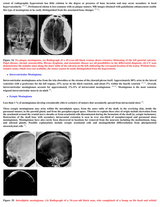 extent of radiographic hyperostosis has little relation to the degree or presence of bone invasion and may occur secondary to local
hypervascularity 35,39. Peritumoral edema is less common with en plaque tumors. MR images obtained with gadolinium enhancement enable
this type of meningioma to be easily distinguished from the associated bone changes 39,46.
Figure 34. En plaque meningioma. (a) Radiograph of a 45-year-old black woman shows extensive thickening of the left parietal calvaria.
Paget disease, chronic osteomyelitis, fibrous dysplasia, and metastatic disease are all possibilities in the differential diagnosis. (b) CT scan
demonstrates the nodular mass along the inner table of the calvaria on the left, indicating the extraaxial location of the lesion. Without bone-
window scans, which were not available, the tumor cannot be easily distinguished from the hyperostosis.
 Intraventricular Meningioma
Intraventricular meningiomas arise from the tela choroidea or the stroma of the choroid plexus itself. Approximately 80% arise in the lateral
ventricles with a preference for the left trigone, 15% occur in the third ventricle, and about 5% within the fourth ventricle 35,47. Overall,
intraventricular meningiomas account for approximately 2%-S% of intracranial meningiomas 38,42. Meningioma is the most common
trigonal intraventricular mass in an adult 48.
 Ectopic Meningioma
Less than 1 % of meningiomas develop extradurally (this is exclusive of tumors that secondarily spread from intracranial sites) 49.
These ectopic meningiomas may arise within the intradiploic space, from the outer table of the skull, in the overlying skin, inside the
paranasal sinuses, in the parotid gland, and from the parapharyngeal space. Theories to explain these sites of origin include derivation from
the arachnoid around the cranial nerve sheaths or from arachnoid cells disseminated during the formation of the skull (ie, ectopic inclusions).
Destruction of the skull base with secondary intracranial extension is seen in over one-third of nasopharyngeal and paranasal sinus
meningiomas. Meningiomas have also rarely been discovered in locations far removed from the neuraxis including the mediastinum, lung,
and adrenal glands. Possible explanations include ectopic arachnoid cells and meningothelial differentiation from pluripotential
mesenchymal cells 35.
Figure 35. Intradiploic meningioma. (A) Radiograph of a 34-year-old black man, who complained of a bump on his head and orbital
 