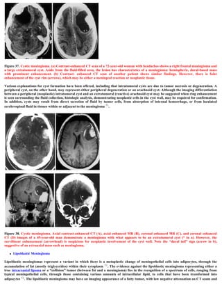 Figure 37. Cystic meningioma. (a) Contrast-enhanced CT scan of a 72-year-old woman with headaches shows a right frontal meningioma and
a large extratumoral cyst. Aside from the fluid-filled area, the lesion has characteristics of a meningioma: hemispheric, dural-based mass
with prominent enhancement. (b) Contrast- enhanced CT scan of another patient shows similar findings. However, there is faint
enhancement of the cyst rim (arrows), which may be either a meningeal reaction or neoplastic tissue.
Various explanations for cyst formation have been offered, including that intratumoral cysts are due to tumor necrosis or degeneration. A
peripheral cyst, on the other hand, may represent either peripheral degeneration or an arachnoid cyst. Although the imaging differentiation
between a peripheral (neoplastic) intratumoral cyst and an extratumoral (reactive) arachnoid cyst may be suggested when ring enhancement
is seen surrounding the fluid collection, histologic analysis, demonstrating neoplastic cells in the cyst wall, may be required for confirmation.
In addition, cysts may result from direct secretion of fluid by tumor cells, from absorption of internal hemorrhage, or from loculated
cerebrospinal fluid in tissues within or adjacent to the meningioma 51.
Figure 38. Cystic meningioma. Axial contrast-enhanced CT (A), axial enhanced MR (B), coronal enhanced MR (C), and coronal enhanced
CT (D) images of a 45-year-old man demonstrate a meningioma with what appears to be an extratumoral cyst (* in a). However, the
curvilinear enhancement (arrowhead) is suspicious for neoplastic involvement of the cyst wall. Note the “dural tail” sign (arrow in b),
suggestive of an extraaxial mass such as meningioma.
 Lipoblastic Meningioma
Lipoblastic meningiomas represent a variant in which there is a metaplastic change of meningothelial cells into adipocytes, through the
accumulation of fat (mostly triglycerides) within their cytoplasm 52. The evidence against the lipoblastic meningioma representing either a
true intracranial lipoma or a “collision” tumor (between fat and a meningioma) lies in the recognition of a spectrum of cells, ranging from
typical meningothelial cells, through those containing various amounts of intracellular lipid, to cells that have been transformed into
adipocytes 52. The lipoblastic meningioma may have an imaging appearance of a fatty tumor, with low negative attenuation on CT scans and
 