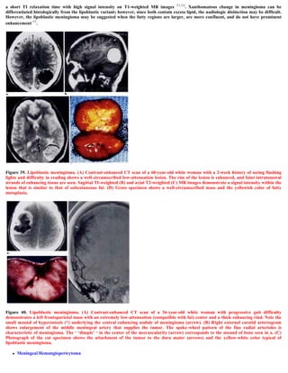 a short TI relaxation time with high signal intensity on T1-weighted MR images 53,54. Xanthomatous change in meningioma can be
differentiated histologically from the lipoblastic variant; however, since both contain excess lipid, the nadiologic distinction may be difficult.
However, the lipoblastic meningioma may be suggested when the fatty regions are larger, are more confluent, and do not have prominent
enhancement 53.
Figure 39. Lipoblastic meningioma. (A) Contrast-enhanced CT scan of a 60-year-old white woman with a 2-week history of seeing flashing
lights and difficulty in reading shows a well-circumscribed low-attenuation lesion. The rim of the lesion is enhanced, and faint intratumoral
strands of enhancing tissue are seen. Sagittal TI-weighted (B) and axial T2-weighted (C) MR images demonstrate a signal intensity within the
lesion that is similar to that of subcutaneous fat. (D) Gross specimen shows a well-circumscribed mass and the yellowish color of fatty
metaplasia.
Figure 40. Lipoblastic meningioma. (A) Contrast-enhanced CT scan of a 36-year-old white woman with progressive gait difficulty
demonstrates a left frontoparietal mass with an extremely low-attenuation (compatible with fat) center and a thick enhancing rind. Note the
small mound of hyperostosis (*) underlying the central enhancing nodule of meningioma (arrow). (B) Right external carotid arteriogram
shows enlargement of the middle meningeal artery that supplies the tumor. The spoke-wheel pattern of the fine radial arterioles is
characteristic of meningioma. The ‘ ‘dimple’ ‘ in the center of the neovascularity (arrow) corresponds to the mound of bone seen in a. (C)
Photograph of the cut specimen shows the attachment of the tumor to the dura mater (arrows) and the yellow-white color typical of
lipoblastic meningioma.
 Meningeal Hemangiopericytoma
 