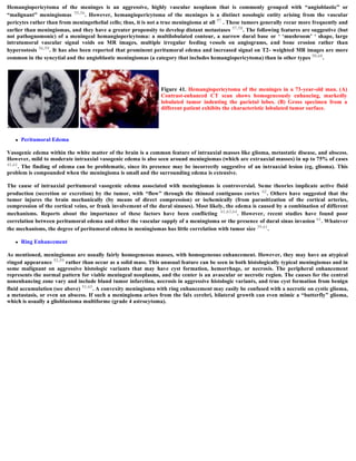 Hemangiopericytoma of the meninges is an aggressive, highly vascular neoplasm that is commonly grouped with “angioblastic” or
“malignant” meningiomas 55,56. However, hemangiopericytoma of the meninges is a distinct nosologic entity arising from the vascular
pericytes rather than from meningothelial cells; thus, it is not a true meningioma at all 57 . These tumors generally recur more frequently and
earlier than meningiomas, and they have a greater propensity to develop distant metastases 57,58. The following features are suggestive (but
not pathognomonic) of a meningeal hemangiopericytoma: a multilobulated contour, a narrow dural base or ‘ ‘mushroom’ ‘ shape, large
intratumoral vascular signal voids on MR images, multiple irregular feeding vessels on angiograms, and bone erosion rather than
hyperostosis 56,59. It has also been reported that prominent peritumoral edema and increased signal on T2- weighted MR images are more
common in the syncytial and the angioblastic meningiomas (a category that includes hemangiopericytoma) than in other types 50,60.
 Peritumoral Edema
Vasogenic edema within the white matter of the brain is a common feature of intraaxial masses like glioma, metastatic disease, and abscess.
However, mild to moderate intraaxial vasogenic edema is also seen around meningiomas (which are extraaxial masses) in up to 75% of cases
41,61. The finding of edema can be problematic, since its presence may be incorrectly suggestive of an intraaxial lesion (eg, glioma). This
problem is compounded when the meningioma is small and the surrounding edema is extensive.
The cause of intraaxial peritumoral vasogenic edema associated with meningiomas is controversial. Some theories implicate active fluid
production (secretion or excretion) by the tumor, with “flow” through the thinned contiguous cortex 62. Others have suggested that the
tumor injures the brain mechanically (by means of direct compression) or ischemically (from parasitization of the cortical arteries,
compression of the cortical veins, or frank involvement of the dural sinuses). Most likely, the edema is caused by a combination of different
mechanisms. Reports about the importance of these factors have been conflicting 61,63,64. However, recent studies have found poor
correlation between peritumoral edema and either the vascular supply of a meningioma or the presence of dural sinus invasion 61. Whatever
the mechanisms, the degree of peritumoral edema in meningiomas has little correlation with tumor size 39,61.
 Ring Enhancement
As mentioned, meningiomas are usually fairly homogeneous masses, with homogeneous enhancement. However, they may have an atypical
ringed appearance 52,59 rather than occur as a solid mass. This unusual feature can be seen in both histologically typical meningiomas and in
some malignant on aggressive histologic variants that may have cyst formation, hemorrhage, or necrosis. The peripheral enhancement
represents the normal pattern for viable meningeal neoplasms, and the center is an avascular or necrotic region. The causes for the central
nonenhancing zone vary and include bland tumor infarction, necrosis in aggressive histologic variants, and true cyst formation from benign
fluid accumulation (see above) 51,65. A convexity meningioma with ring enhancement may easily be confused with a necrotic on cystic glioma,
a metastasis, or even an abscess. If such a meningioma arises from the falx cerebri, bilateral growth can even mimic a “butterfly” glioma,
which is usually a glioblastoma multiforme (grade 4 astrocytoma).
Figure 41. Hemangiopericytoma of the meninges in a 73-year-old man. (A)
Contrast-enhanced CT scan shows homogeneously enhancing, markedly
lobulated tumor indenting the parietal lobes. (B) Gross specimen from a
different patient exhibits the characteristic lobulated tumor surface.
 