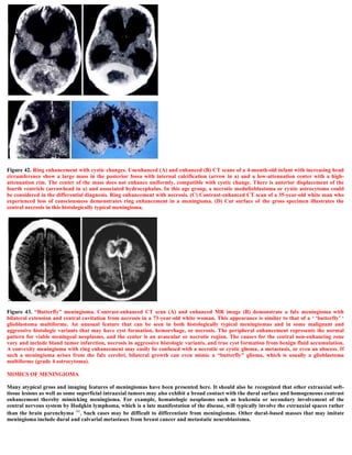 Figure 42. Ring enhancement with cystic changes. Unenhanced (A) and enhanced (B) CT scans of a 4-month-old infant with increasing head
circumference show a large mass in the posterior fossa with internal calcification (arrow in a) and a low-attenuation center with a high-
attenuation rim. The center of the mass does not enhance uniformly, compatible with cystic change. There is anterior displacement of the
fourth ventricle (arrowhead in a) and associated hydrocephalus. In this age group, a necrotic medulloblastoma or cystic astrocytoma could
be considered in the differential diagnosis. Ring enhancement with necrosis. (C) Contrast-enhanced CT scan of a 35-year-old white man who
experienced loss of consciousness demonstrates ring enhancement in a meningioma. (D) Cut surface of the gross specimen illustrates the
central necrosis in this histologically typical meningioma.
Figure 43. “Butterfly” meningioma. Contrast-enhanced CT scan (A) and enhanced MR image (B) demonstrate a falx meningioma with
bilateral extension and central cavitation from necrosis in a 73-year-old white woman. This appearance is similar to that of a ‘ ‘butterfly’ ‘
glioblastoma multiforme. An unusual feature that can be seen in both histologically typical meningiomas and in some malignant and
aggressive histologic variants that may have cyst formation, hemorrhage, or necrosis. The peripheral enhancement represents the normal
pattern for viable meningeal neoplasms, and the center is an avascular or necrotic region. The causes for the central non-enhancing zone
vary and include bland tumor infarction, necrosis in aggressive histologic variants, and true cyst formation from benign fluid accumulation.
A convexity meningioma with ring enhancement may easily be confused with a necrotic or cystic glioma, a metastasis, or even an abscess. If
such a meningioma arises from the falx cerebri, bilateral growth can even mimic a “butterfly” glioma, which is usually a glioblastoma
multiforme (grade 4 astrocytoma).
MIMICS OF MENINGIOMA
Many atypical gross and imaging features of meningiomas have been presented here. It should also be recognized that other extraaxial soft-
tissue lesions as well as some superficial intraaxial tumors may also exhibit a broad contact with the dural surface and homogeneous contrast
enhancement thereby mimicking meningioma. For example, hematologic neoplasms such as leukemia or secondary involvement of the
central nervous system by Hodgkin lymphoma, which is a late manifestation of the disease, will typically involve the extraaxial spaces rather
than the brain parenchyma 66. Such cases may be difficult to differentiate from meningiomas. Other dural-based masses that may imitate
meningioma include dural and calvarial metastases from breast cancer and metastatic neuroblastoma.
 