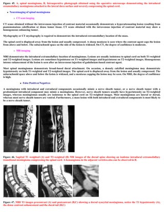 Figure 45. A, spinal meningioma, B, Intraoperative photograph obtained using the operative microscope demonstrating the intradural
extamedullary meningioma attached to the lateral dura surface and severely compressing the spinal cord.
 Neuroimaging of spinal meningioma
 CT scan inaging
CT scans obtained without the intravenous injection of contrast material occasionally demonstrate a hyperattenuating lesion resulting from
psammomatous calcification or dense tumor tissue. CT scans obtained with the intravenous injection of contrast material may show a
homogeneous enhancing tumor.
Myelography or CT myelography is required to demonstrate the intradural extramedullary location of the mass.
The spinal cord is displaced away from the lesion and usually compressed. A sharp meniscus is seen where the contrast agent caps the lesion
from above and below. The subarachnoid space on the side of the lesion is widened. On CT, the degree of confidence is moderate.
 MR imaging
MRI demonstrates the intradural extramedullary location of meningiomas. Lesions are usually isointense to spinal cord on both T1-weighted
and T2-weighted images. Lesions are sometimes hypointense on T1-weighted images and hyperintense on T2-weighted images. Homogeneous
intense enhancement of the lesion is seen after an intravenous injection of gadolinium-based contrast agent.
Most spinal meningiomas demonstrate broad-based dural attachment. On occasion, a densely calcified meningioma may demonstrate
hypointensity on both T1-weighted and T2-weighted images. The spinal cord is displaced away from the lesion and usually compressed. The
subarachnoid space above and below the lesion is widened, and a meniscus capping the lesion may be seen. On MRI, the degree of confidence
is high.
 False Positives/Negatives
A meningioma with intradural and extradural components occasionally mimic a nerve sheath tumor, or a nerve sheath tumor with a
predominant intradural component may mimic a meningioma. However, nerve sheath tumors usually have hyperintensity on T2-weighted
images, whereas meningiomas usually are isointense to the spinal cord on T2-weighted images. Most meningiomas are lateral or dorsal,
whereas most nerve sheath tumors are ventral. Furthermore, a mass lesion with both intradural and extradural components is most likely to
be a nerve sheath tumor.
Figure 46. Sagittal Tl -weighted (A) and T2-weighted (B) MR images of the dorsal spine showing an isodense intradural extramedullary
transitional meningioma compressing the spinal cord. A hemangioma in the adjacent vertebra also can be observed in B.
Figure 47. MRI T1 images precontrast (A) and postcontrast (B,C) showing a dorsal syncytial meningioma, notice the T1 hypointensity (A),
the dense contrast enhancement and the dural tail (B,C)
 