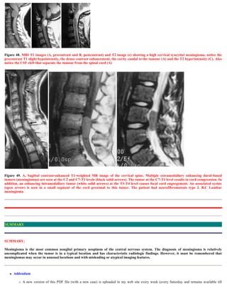 Figure 48. MRI T1 images (A, precontrast and B, postcontrast) and T2 image (c) showing a high cervical syncytial meningioma, notice the
precontrast T1 slight hypointensity, the dense contrast enhancement, the cavity caudal to the tumour (A) and the T2 hyperintensity (C). Also
notice the CSF cleft that separate the tumour from the spinal cord (A)
Figure 49. A, Sagittal contrast-enhanced T1-weighted MR image of the cervical spine. Multiple extramedullary enhancing dural-based
tumors (meningiomas) are seen at the C2 and C7-T1 levels (black solid arrows). The tumor at the C7-T1 level results in cord compression. In
addition, an enhancing intramedullary tumor (white solid arrows) at the T3-T4 level causes focal cord engorgement. An associated syrinx
(open arrow) is seen in a small segment of the cord proximal to this tumor. The patient had neurofibromatosis type 2. B,C Lumbar
meningioma
SUMMARY:
Meningioma is the most common nonglial primary neoplasm of the central nervous system. The diagnosis of meningioma is relatively
uncomplicated when the tumor is in a typical location and has characteristic radiologic findings. However, it must be remembered that
meningiomas may occur in unusual locations and with misleading or atypical imaging features.
 Addendum
 A new version of this PDF file (with a new case) is uploaded in my web site every week (every Saturday and remains available till
SUMMARY
 