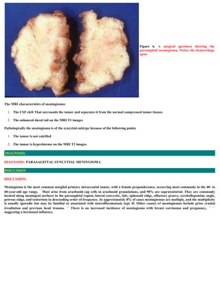 The MRI characteristics of meningiomas
1. The CSF cleft That surrounds the tumor and separates it from the normal compressed tumor tissues
2. The enhanced dural tail on the MRI T1 images
Pathologically the meningioma is of the syncytial subtype because of the following points
1. The tumor is not calcified
2. The tumor is hyperintense on the MRI T2 images
DIAGNOSIS: PARASAGITTAL SYNCYTIAL MENINGIOMA
DISCUSSION:
Meningioma is the most common nonglial primary intracranial tumor, with a female preponderance, occurring most commonly in the 40- to
60-year-old age range. 7 Most arise from arachnoid cap cells in arachnoid granulations, and 90% are supratentorial. They are commonly
located along meningeal surfaces in the parasagittal region, lateral convexity, falx, sphenoid ridge, olfactory groove, cerebellopontine angle,
petrous ridge, and tentorium in descending order of frequency. In approximately 8% of cases meningiomas are multiple, and the multiplicity
is usually sporadic but may be familial or associated with neurofibromatosis type II. Other causes of meningiomas include prior cranial
irradiation and previous head trauma. 10 There is an increased incidence of meningioma with breast carcinoma and pregnancy, 11,12
suggesting a hormonal influence.
Figure 6. A surgical specimen showing the
parasagittal meningioma, Notice the hemorrhage
spots
DIAGNOSIS:
DISCUSSION
 