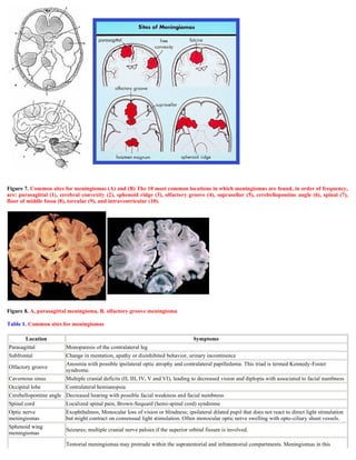 Figure 7. Common sites for meningiomas (A) and (B) The 10 most common locations in which meningiomas are found, in order of frequency,
are: parasagittal (1), cerebral convexity (2), sphenoid ridge (3), olfactory groove (4), suprasellar (5), cerebellopontine angle (6), spinal (7),
floor of middle fossa (8), torcular (9), and intraventricular (10).
Figure 8. A, parasagittal meningioma, B, olfactory groove meningioma
Table 1. Common sites for meningiomas
Location Symptoms
Parasagittal Monoparesis of the contralateral leg
Subfrontal Change in mentation, apathy or disinhibited behavior, urinary incontinence
Olfactory groove
Anosmia with possible ipsilateral optic atrophy and contralateral papilledema. This triad is termed Kennedy-Foster
syndrome.
Cavernous sinus Multiple cranial deficits (II, III, IV, V and VI), leading to decreased vision and diplopia with associated to facial numbness
Occipital lobe Contralateral hemianopsia
Cerebellopontine angle Decreased hearing with possible facial weakness and facial numbness
Spinal cord Localized spinal pain, Brown-Sequard (hemi-spinal cord) syndrome
Optic nerve
meningiomas
Exophthalmos, Monocular loss of vision or blindness; ipsilateral dilated pupil that does not react to direct light stimulation
but might contract on consensual light stimulation. Often monocular optic nerve swelling with opto-ciliary shunt vessels.
Sphenoid wing
meningiomas
Seizures; multiple cranial nerve palsies if the superior orbital fissure is involved.
Tentorial meningiomas may protrude within the supratentorial and infratentorial compartments. Meningiomas in this
 