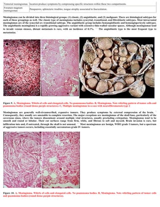 Meningiomas can be divided into three histological groups: (1) classic, (2) angioblastic, and (3) malignant. There are histological subtypes for
each of these groupings as well. The classic type of meningioma includes syncytial, transitional, and fibroblastic subtypes. Most intracranial
meningiomas are of the syncytial or; transitional subtype. The angioblastic group includes hemangioblastic and hemangiopericytic subtypes.
The angioblastic meningioma is a rapidly growing aggressive variant with extensive thin-walled vascular spaces. Although meningiomas tend
to invade venous sinuses, distant metastasis is rare, with an incidence of 0.1%. 13 The angioblastic type is the most frequent type to
metastasize. 7
Figure 9. A, Meningioma. Whirls of cells and elongated cells. No psammoma bodies. B, Meningioma. Note whirling pattern of tumor cells and
psammoma bodies (round dense purple structures). C, Multiple meningiomas in a case with neurofibromatosis type 2
Meningiomas are generally well-circumscribed, expansive tumors. They produce symptoms by external compression of the brain. 2
Consequently, they usually are amenable to complete resection. The major exceptions are meningiomas of the skull base, particularly of the
cavernous sinus, where the tumors disseminate around multiple vital structures, usually precluding extirpation. Meningiomas tend to be
smooth and round or lobular. Their cut surfaces range from firm, white, and fibrous to soft and myxoid. Brain invasion is rare, but
infiltration into and, if untreated, through the skull is not unusual. 1,2 Most meningiomas are benign, WHO grade I tumors, but a spectrum
of aggressive tumors occurs, including essentially sarcomatous grade IV tumors.
Figure 10. A, Meningioma. Whirls of cells and elongated cells. No psammoma bodies. B, Meningioma. Note whirling pattern of tumor cells
and psammoma bodies (round dense purple structures).
Tentorial meningiomas location produce symptoms by compressing specific structures within these two compartments.
Foramen magnum
meningiomas
Paraparesis; sphincteric troubles; tongue atrophy associated to fasciculation.
 