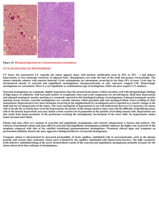 Figure 12. Histopathological picture of psammomatous meningioma
CT SCAN IMAGING OF MENINGIOMAS
CT Scans. On noncontrast CT, typically the tumor appears dense with intrinsic calcification (seen in 20% to 25% 14) and induces
hyperostosis, or less commonly osteolysis, of adjacent bone. Meningiomas can erode the base of the skull and project extracranially. The
tumors intensely enhance with contrast material. Cystic meningiomas are uncommon, occurring in less than 10% of cases. Cysts may be
intratumoral (mostly in syncytial and angioblastic meningiomas), intraparenchymal, or may represent trapped CSF. Hemorrhagic
meningiomas are uncommon. There is a rare lipoblastic or xanthomatous type of meningioma, which can show negative CT numbers.
Syncytial meningiomas are commonly slightly hyperdense than the normal brain tissues (which correlates well with histopathologic findings
of high degree of cellularity, with increased nuclear to cytoplasmic ratio) and cystic components are not infrequent. Skull bone hyperostosis
and enlarged meningeal vascular marking are commonly reported in this histological subtype of meningiomas. Enlarged meningeal vascular
marking occurs because syncytial meningiomas are vascular tumours which parasitize pial and meningeal blood vessel resulting in their
enlargement. Hyperostosis is new bone formation occurring in the neighborhood of a meningioma and is regarded as a reactive change in the
skull and not an integral part of the tumor. The exact mechanism of hyperostosis is not well understood, however it is necessary for tumor
cells to invade the overlying bone to invoke hyperostosis, the density of the change found in some cases and the difficulty of identifying tumor
cells in the densely hyperostotic area may denote a bone reaction out of proportion to the quantity of invading tumour cells. Hyperostosis can
also result from hypervascularity of the periosteum overlying the meningiomas. Involvement of the outer table -by hyperostosis- makes
tumor invasion more likely.
Edema and mass effect are common in syncytial and angioblastic meningiomas and contrast enhancement is intense and uniform. The
existence of prominent edema and mass effect in syncytial and angioblastic meningiomas probably indicates the higher rate of growth of this
neoplasm compared with that of the calcified transitional (psammomatous) meningiomas. Prominent clinical signs and symptoms on
presentation definitely denotes the more aggressive biological behavior of syncytial meningiomas.
Vasogenic edema is characterized by increased permeability of brain capillary endothelial cells to macromolecules, such as the plasma
proteins and various other molecules, whose entry is limited by the capillary endothelial cells (blood brain barrier). The high vascularity
(with defective endothelial lining of the newly formed blood vessels) of the syncytial and angioblastic meningiomas probably accounts for the
edema observed in these subtypes of meningiomas.
 