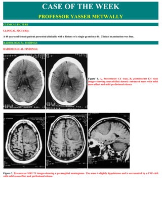 CLINICAL PICTURE:
A 40 years old female patient presented clinically with a history of a single grand mal fit. Clinical examination was free.
RADIOLOGICAL FINDINGS:
Figure 2. Precontrast MRI T1 images showing a parasagittal meningioma. The mass is slightly hypointense and is surrounded by a CSF cleft
with mild mass effect and perilesional edema.
CASE OF THE WEEK
PROFESSOR YASSER METWALLY
CLINICAL PICTURE
RADIOLOGICAL FINDINGS
Figure 1. A, Precontrast CT scan, B, postcontrast CT scan
images showing noncalcified densely enhanced mass with mild
mass effect and mild perilesional edema
 