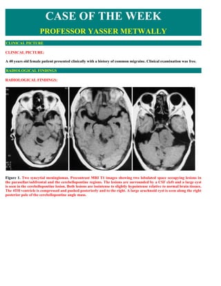 CASE OF THE WEEK
                     PROFESSOR YASSER METWALLY
CLINICAL PICTURE

CLINICAL PICTURE:

A 40 years old female patient presented clinically with a history of common migraine. Clinical examination was free.

RADIOLOGICAL FINDINGS

RADIOLOGICAL FINDINGS:




Figure 1. Two syncytial meningiomas. Precontrast MRI T1 images showing two lobulated space occupying lesions in
the parasellar/subfrontal and the cerebellopontine regions. The lesions are surrounded by a CSF cleft and a large cyst
is seen in the cerebellopontine lesion. Both lesions are isointense to slightly hypointense relative to normal brain tissues.
The 4TH ventricle is compressed and pushed posteriorly and to the right. A large arachnoid cyst is seen along the right
posterior pole of the cerebellopontine angle mass.
 
