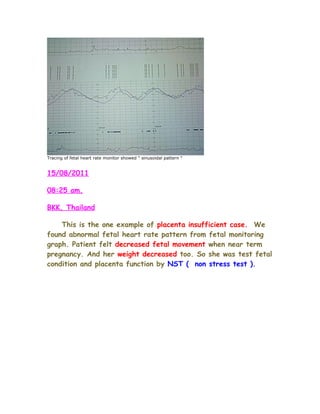 Tracing of fetal heart rate monitor showed " sinusoidal pattern "


15/08/2011

08:25 am.

BKK, Thailand

    This is the one example of placenta insufficient case. We
found abnormal fetal heart rate pattern from fetal monitoring
graph. Patient felt decreased fetal movement when near term
pregnancy. And her weight decreased too. So she was test fetal
condition and placenta function by NST ( non stress test ).
 