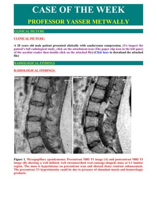 CASE OF THE WEEK
          PROFESSOR YASSER METWALLY
CLINICAL PICTURE

CLINICAL PICTURE:

A 20 years old male patient presented clinically with cauda/conus compression. (To inspect the
patient's full radiological study, click on the attachment icon (The paper clip icon in the left pane)
of the acrobat reader then double click on the attached file) (Click here to download the attached
file)

RADIOLOGICAL FINDINGS

RADIOLOGICAL FINDINGS:




Figure 1. Myxopapillary ependymoma: Precontrast MRI T1 image (A) and postcontrast MRI T1
image (B) showing a well defined, well circumscribed oval (sausage-shaped) mass at L1 lumbar
region. The mass is hyperintense on precontrast scan and showed dense contrast enhancement.
The precontrast T1 hyperintensity could be due to presence of abundant mucin and hemorrhagic
products.
 