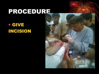 PROCEDURE GIVE INCISION