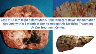 Case of 18 mm right kidney stone Hepatomegaly and Bowel Inflammation and Homoeopathy