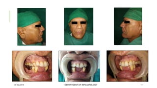 Case of immediate implant placement using bone ring technique | PPTX