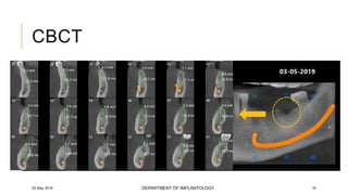 Case of immediate implant placement using bone ring technique | PPTX
