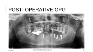 Case of immediate implant placement using bone ring technique | PPTX