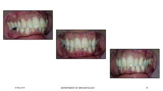 Case of immediate implant placement using bone ring technique | PPTX
