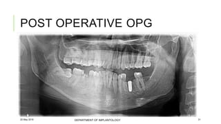 Case of immediate implant placement using bone ring technique | PPTX