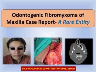 Odontogenic Fibromyxoma of
Maxilla Case Report- A Rare Entity
DR. BHAVIK MIYANI, DEPARTMENT OF OMFS, NPDCH
 