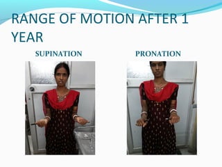 RANGE OF MOTION AFTER 1
YEAR
SUPINATION PRONATION
 