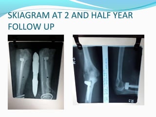 SKIAGRAM AT 2 AND HALF YEAR
FOLLOW UP
 