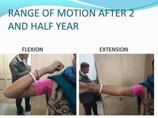 RANGE OF MOTION AFTER 2
AND HALF YEAR
FLEXION EXTENSION
 