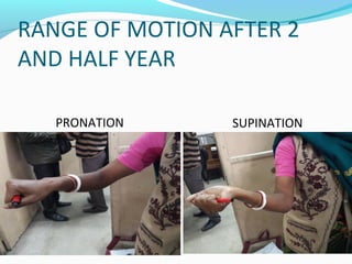 RANGE OF MOTION AFTER 2
AND HALF YEAR
PRONATION SUPINATION
 