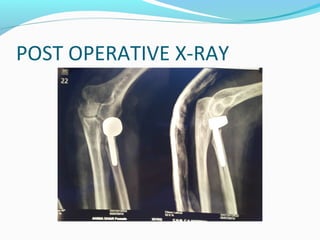 POST OPERATIVE X-RAY
 