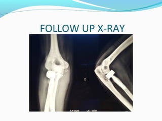 FOLLOW UP X-RAY
 