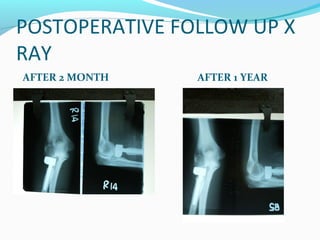 POSTOPERATIVE FOLLOW UP X
RAY
AFTER 2 MONTH AFTER 1 YEAR
 