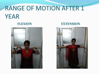 RANGE OF MOTION AFTER 1
YEAR
FLEXION EXTENSION
 