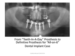 From “Teeth-In-A-Day” Prosthesis to
Definitive Prosthesis for “All-on-6”
Dental Implant Case
LIZANO IMPLANT DENTISTRY
 