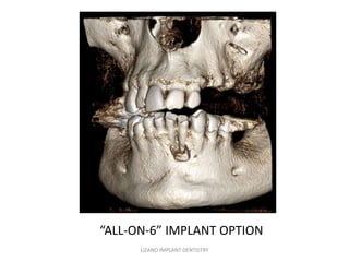“ALL-ON-6” IMPLANT OPTION
LIZANO IMPLANT DENTISTRY

 