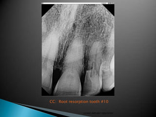 CC: Root resorption tooth #10

                LIZANO IMPLANT DENTISTRY
 