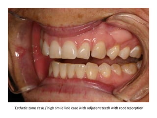 Esthetic zone case / high smile line case with adjacent teeth with root resorption
 