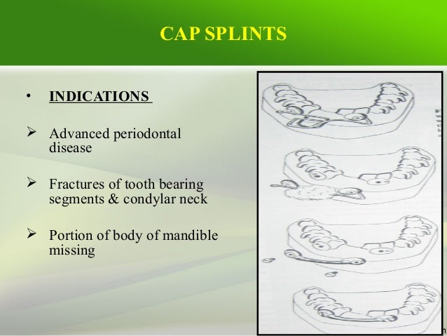 Miniplates osteosynthesis middle facial 03 picture