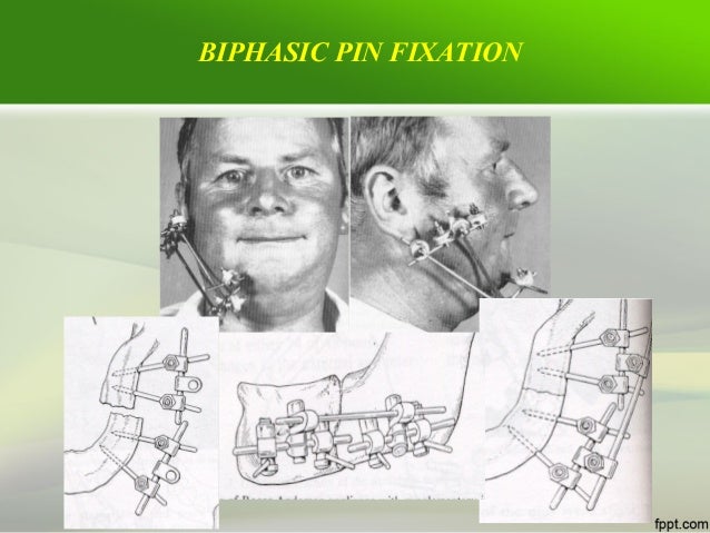 Miniplates osteosynthesis middle facial 06 image