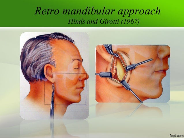 Miniplates osteosynthesis middle facial 08 picture