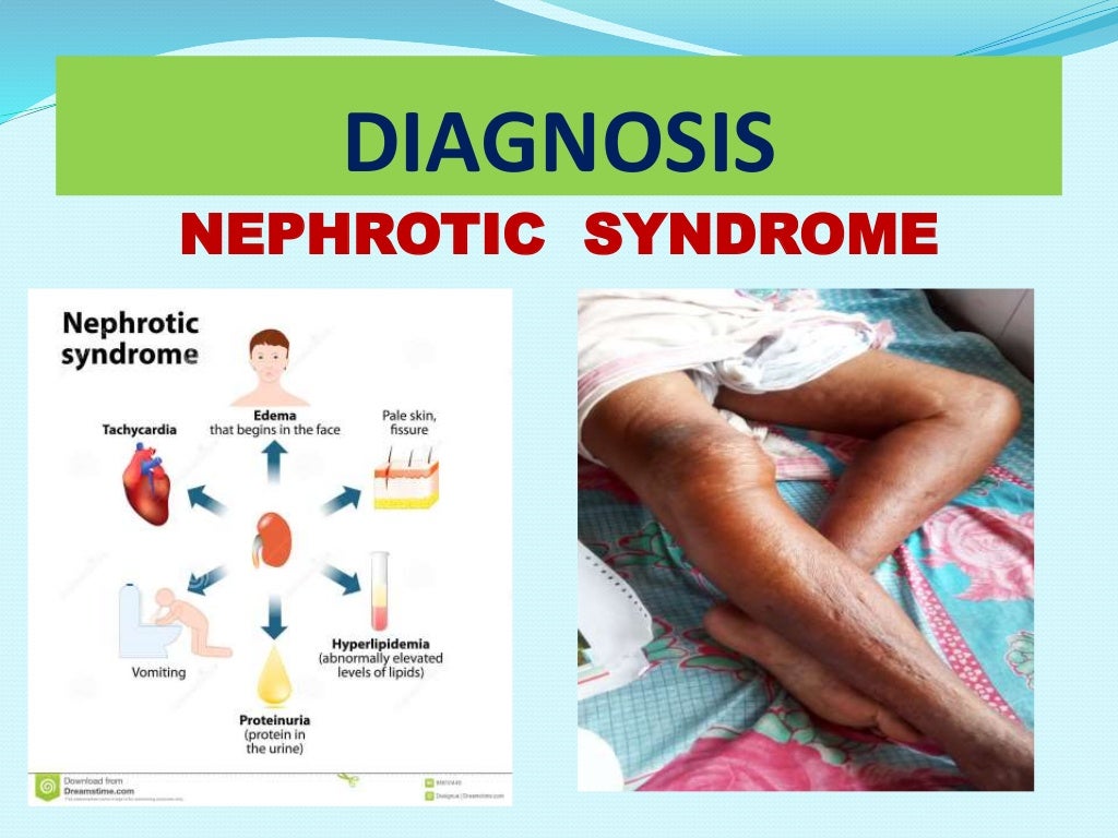 clinical presentation of nephrotic syndrome