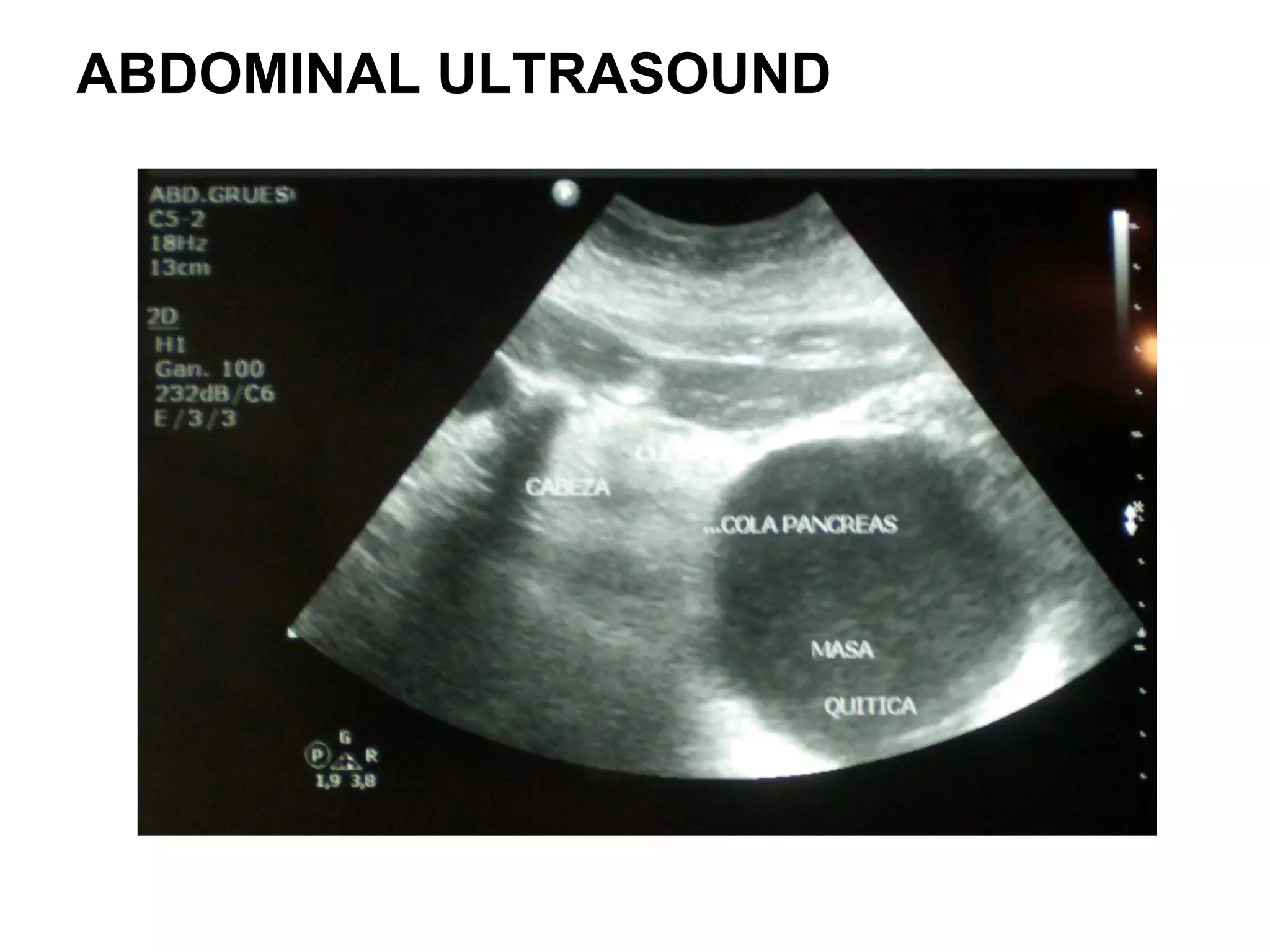 Case Pancreatic Cyst PPT