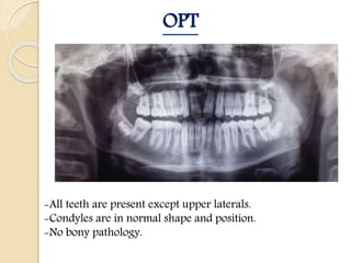 Condyles Opt Dr-Ali Alseyani Case persentation | PPTX
