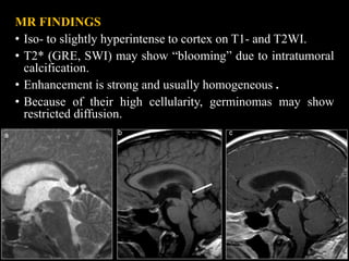 MR FINDINGS
• Iso- to slightly hyperintense to cortex on T1- and T2WI.
• T2* (GRE, SWI) may show “blooming” due to intratumoral
calcification.
• Enhancement is strong and usually homogeneous .
• Because of their high cellularity, germinomas may show
restricted diffusion.
16
 