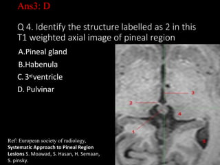 Ans3: D
Q 4. Identify the structure labelled as 2 in this
T1 weighted axial image of pineal region
A.Pineal gland
B.Habenula
C.3rdventricle
D. Pulvinar
27
Ref: European society of radiology,
Systematic Approach to Pineal Region
Lesions S. Moawad, S. Hasan, H. Semaan,
S. pinsky.
 