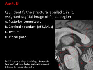 Ans4: B
Q 5. Identify the structure labelled 1 in T1
weighted sagittal image of Pineal region
A. Posterior commissure
B. Cerebral aqueduct (of Sylvius)
C. Tectum
D. Pineal gland
28
Ref: European society of radiology, Systematic
Approach to Pineal Region Lesions S. Moawad,
S. Hasan, H. Semaan, S. pinsky.
 