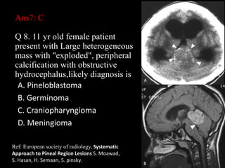 Ans7: C
Q 8. 11 yr old female patient
present with Large heterogeneous
mass with "exploded", peripheral
calcification with obstructive
hydrocephalus,likely diagnosis is
A. Pineloblastoma
B. Germinoma
C. Craniopharyngioma
D. Meningioma
31
Ref: European society of radiology, Systematic
Approach to Pineal Region Lesions S. Moawad,
S. Hasan, H. Semaan, S. pinsky.
 