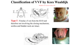 case ppt VVF fistula formation in obg .pptx