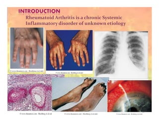 Clinical Presentation on Rheumatoid Arthritis (Amavata) | PDF