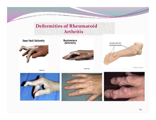 the clinical presentation of rheumatoid arthritis