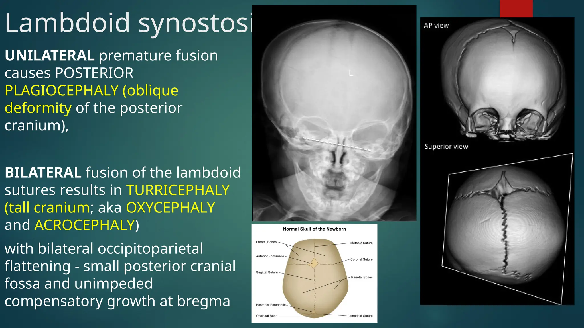 Lambdoid synostosis
UNILATERAL premature fusion
causes POSTERIOR
PLAGIOCEPHALY (oblique
deformity of the posterior
cranium),
BILATERAL fusion of the lambdoid
sutures results in TURRICEPHALY
(tall cranium; aka OXYCEPHALY
and ACROCEPHALY)
with bilateral occipitoparietal
flattening - small posterior cranial
fossa and unimpeded
compensatory growth at bregma
 